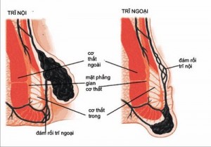 Bệnh trĩ là gì Bệnh trĩ là gì
