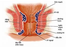 trĩ nội trĩ ngoại, trĩ nội và trĩ ngoại