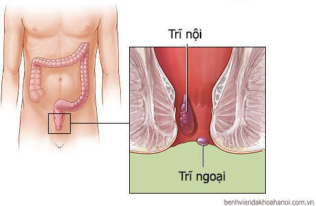nguyên nhân bệnh trĩ