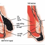 Permalink to Các phương pháp phẫu thuật cắt trĩ cắt trĩ ở đâu