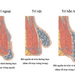trĩ nội trĩ ngoại | tri hon hop