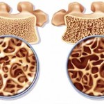 Permalink to Biện pháp điều trị loãng xương: Không dùng thuốc và bằng thuốc benh-loang-loang-xuong