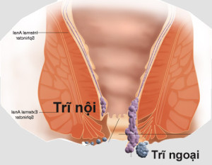 Tìm hiểu về các triệu chứng của bệnh trĩ