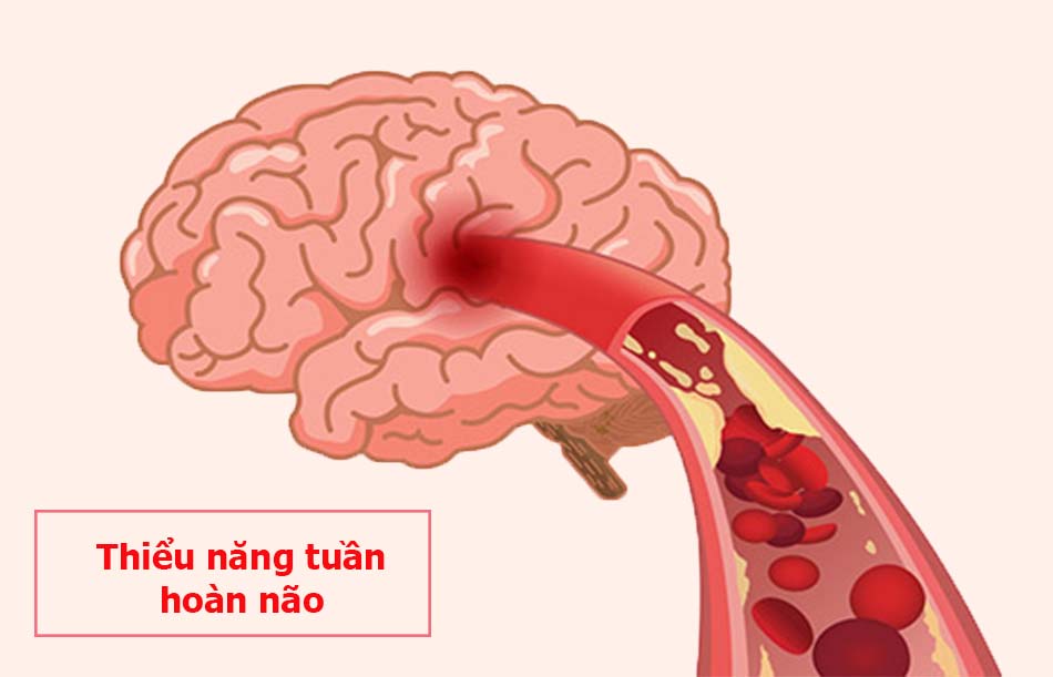 Thiểu năng tuần hoàn não: Nguyên nhân, triệu chứng và cách điều trị