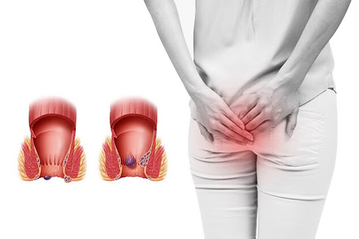 10 Cách chữa bệnh trĩ nội hiệu quả phổ biến hiện nay