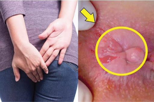 cách chữa trĩ ngoại độ 1