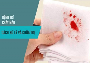 Bệnh trĩ chảy máu phải làm sao? Bệnh trĩ chảy máu phải làm sao?