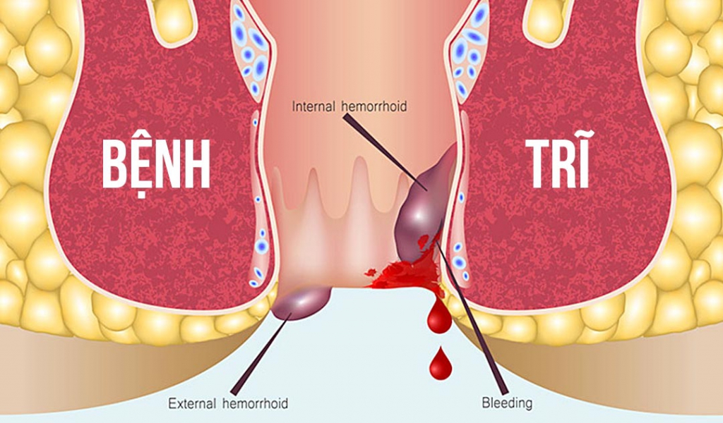 Những điều cần biết về bệnh trĩ cho mọi đối tượng Những điều cần biết về bệnh trĩ cho mọi đối tượng