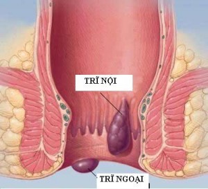 bệnh trĩ ngoại