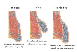 trĩ nội trĩ ngoại | tri hon hop