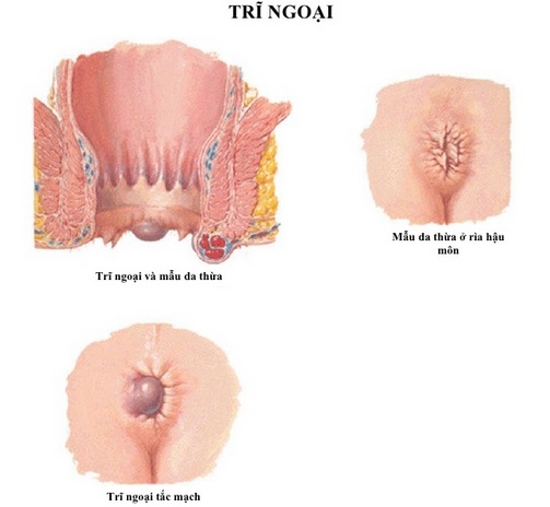 trĩ nội trĩ ngoại | trĩ ngoại