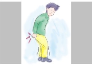 triệu chứng bệnh trĩ hỗn hợp