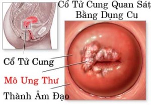ung-thu-co-tu-cung