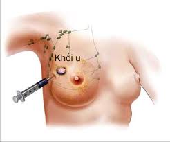 ung-thu-vu-1