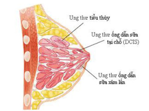 ung-thu-vu