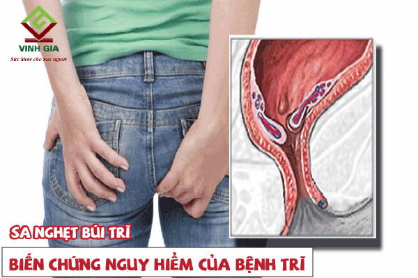Cẩn thận với biến chứng của bệnh trĩ sa nghẹt hậu môn Cẩn thận với biến chứng của bệnh trĩ sa nghẹt hậu môn