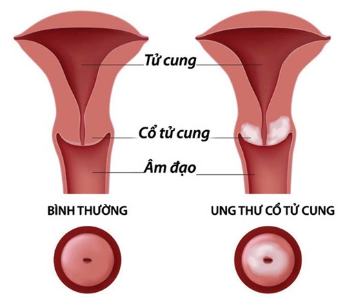 Tránh ung thư cổ tử cung, chớ lơ là biến chứng viêm nhiễm phụ khoa