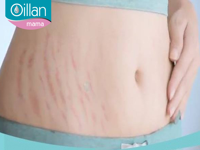 Chữa trị rạn da sau sinh thế nào cho đúng