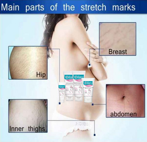 Xóa bỏ những vết rạn da sau sinh chỉ trong vài tuần
