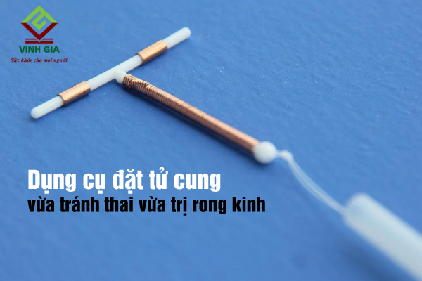 Dụng cụ đặt tử cung vừa tránh thai vừa trị rong kinh hiệu quả