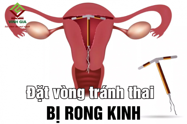 Tại sao đặt vòng tránh thai xong bị rong kinh?