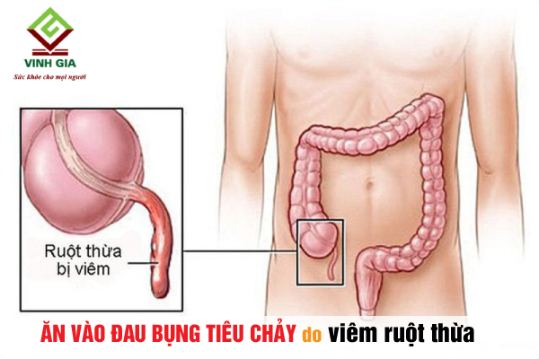 Nguyên nhân ăn xong đau bụng tiêu chảy do viêm ruột thừa