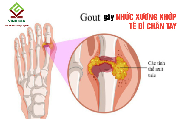 Bị đau xương khớp và tê nhức chân tay có thể là do bệnh Gout