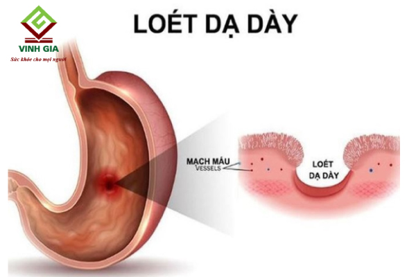 Bị viêm loét dạ dày có thể gây ra tình trạng tiêu chảy ra máu