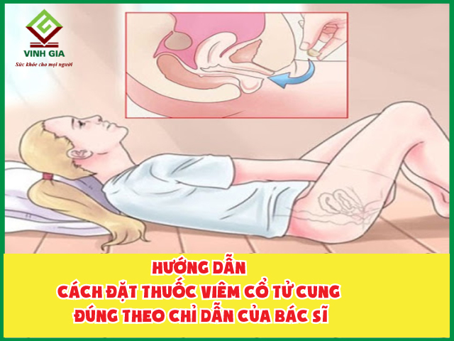 Hướng dẫn cách đặt thuốc viêm cổ tử cung chuẩn nhất