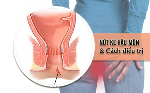 Nứt kẽ hậu môn là gì? Nguyên nhân, triệu chứng, giải pháp