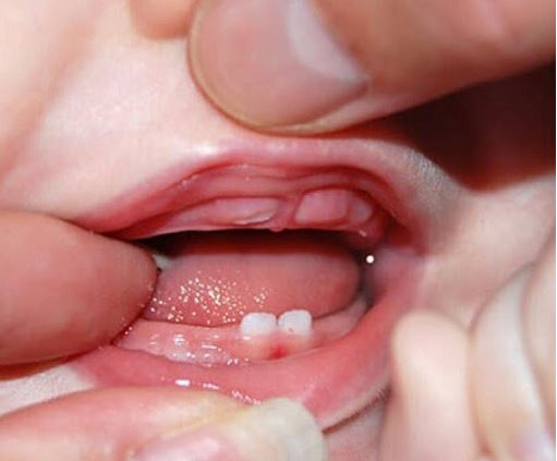 Mọc răng ở trẻ có gây sốt và tiêu chảy? Tre-bi-sot-va-tieu-chay-khi-moc-rang-me-can-lam-gi