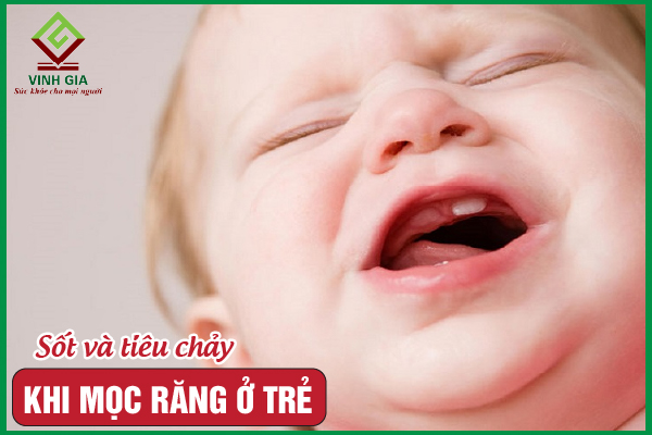 Trẻ bị sốt và tiêu chảy khi mọc răng, mẹ cần làm gì?