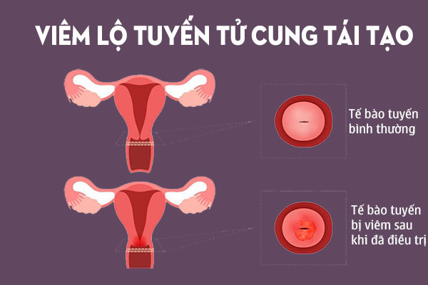 Viêm tái tạo cổ tử cung: Nguyên nhân, dấu hiệu và điều trị