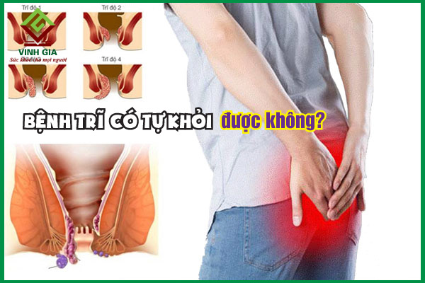 Bệnh trĩ có tự khỏi được không?