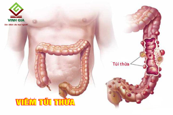 Bệnh viêm túi thừa là tác nhân gây tiêu chảy ra máu