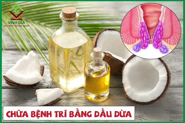 Cách làm dịu triệu chứng bệnh trĩ bằng dầu dừa đơn giản