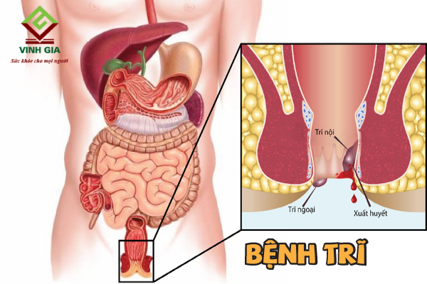 Đau bụng tiêu chảy ra máu là dấu hiệu của bệnh trĩ