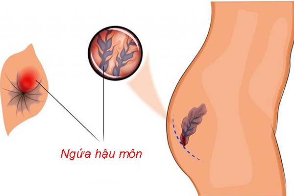 Ngứa hậu môn – “nỗi khổ thầm kín” ở nhiều người