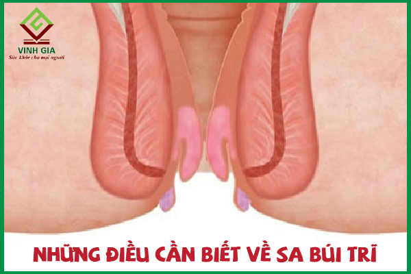 Sa búi trĩ là gì? Các biện pháp làm dịu cực kỳ hiệu quả