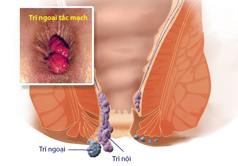 Trĩ ngoại tắc mạch: Nguyên nhân và cách cải thiện hiệu quả