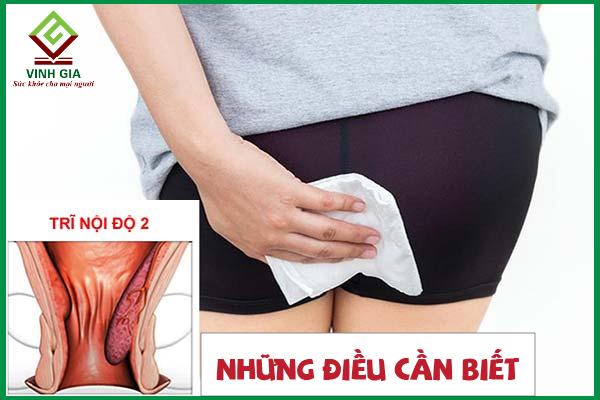 Bệnh trĩ nội độ 2 chữa như thế nào và nên lưu ý gì?