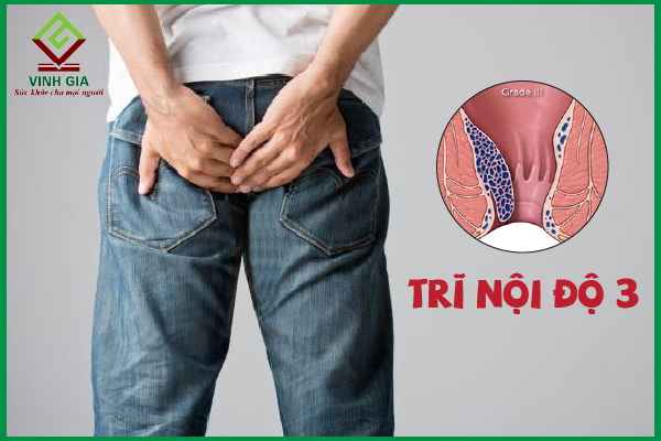 Trĩ nội độ 3 – Có cần thiết phải thực hiện phẫu thuật?