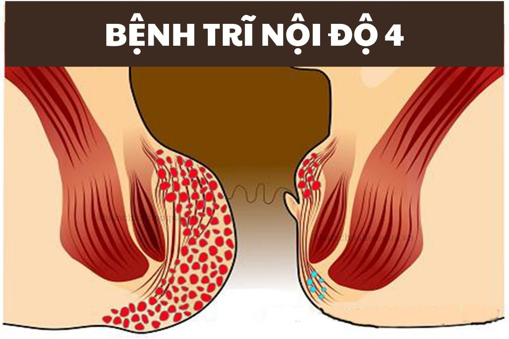 Trĩ nội độ 4 là bệnh gì? Điều trị sao cho nhanh khỏi Trĩ nội độ 4 là bệnh gì? Điều trị sao cho nhanh khỏi