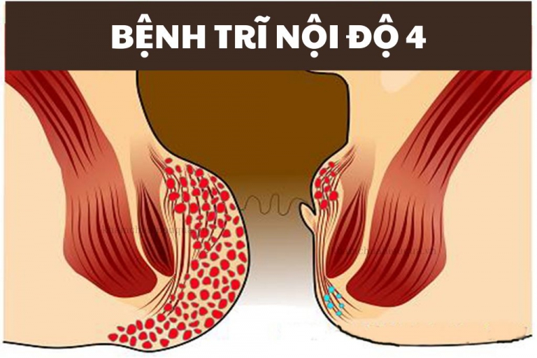 Trĩ nội độ 4 – giai đoạn nguy hiểm nhất của bệnh
