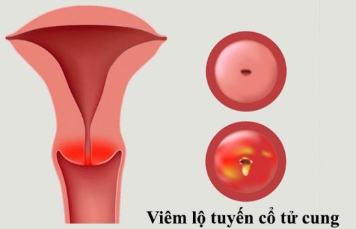 Bệnh viêm lộ tuyến có chữa khỏi được không?