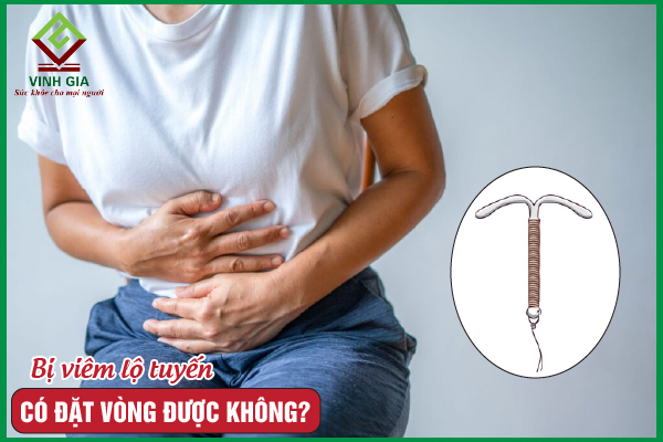 Nhiều chị em quan tâm: Bị viêm lộ tuyến có đặt vòng được không?