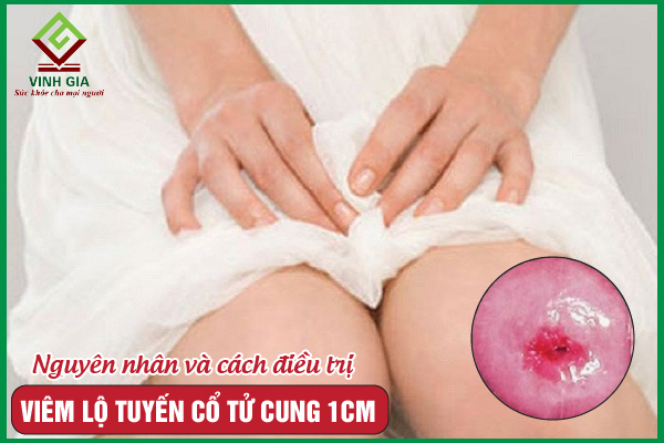 Viêm lộ tuyến cổ tử cung 1cm và các cách điều trị