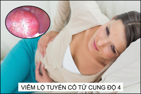 Thế nào là viêm lộ tuyến cổ tử cung độ 4?
