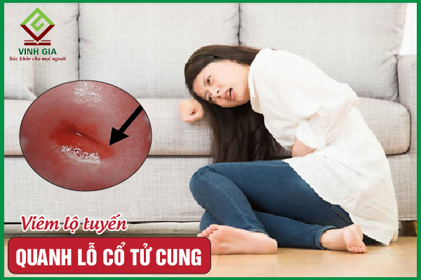 Viêm lộ tuyến quanh lỗ cổ tử cung có nguy hiểm không?