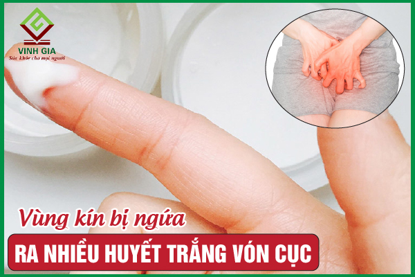 Vùng kín bị ngứa và có dịch trắng vón cục phải làm sao?